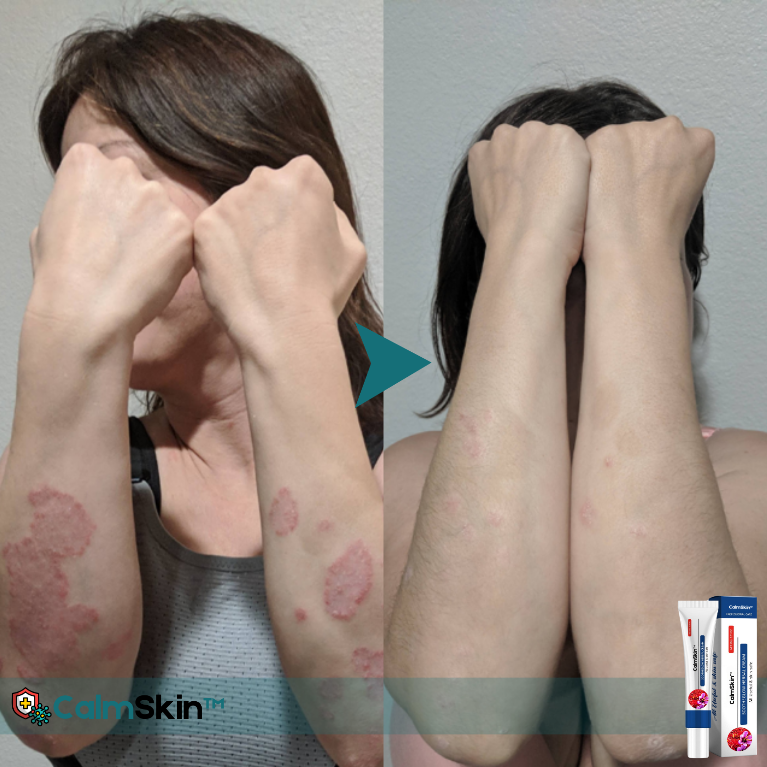 CalmSkin™ Geavanceerde Kruidenherstellende Crème