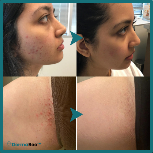 DermaBee™ Bijengif Regeneratiecrème
