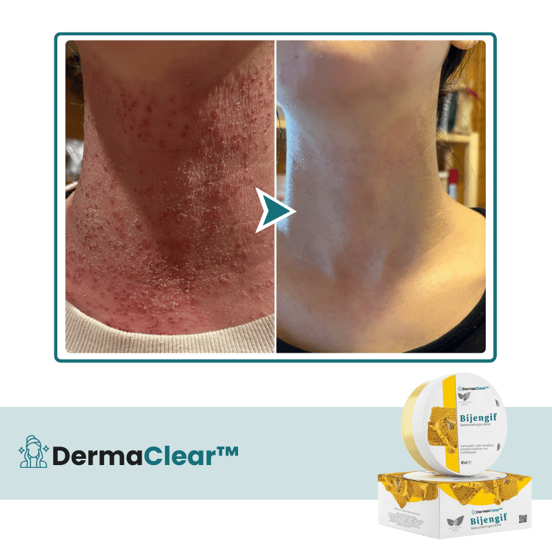 DermaClear™ Huidbehandelingscrème