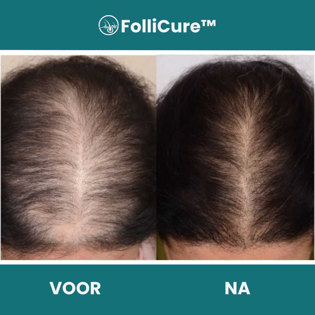 FolliCure™ Anti-Haaruitval Shampoo