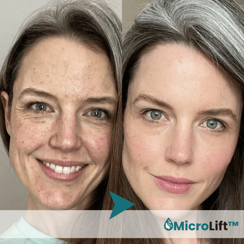 MicroLift™ Micro-Infusiesysteem